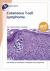 Fast Facts: Cutaneous T-Cell Lymphoma