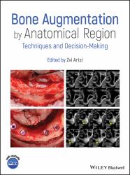 Bone Augmentation by Anatomical Region : Techniques and Decision-Making