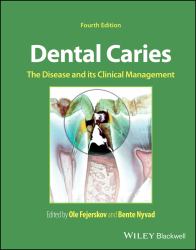 Dental Caries : The Disease and Its Clinical Management