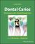 Dental Caries : The Disease and Its Clinical Management