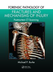 Forensic Pathology of Fractures and Mechanisms of Injury