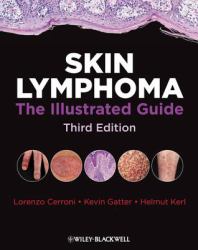 Skin Lymphoma