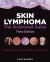 Skin Lymphoma