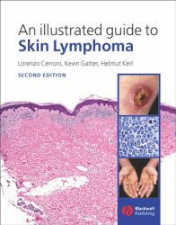 An Illustrated Guide to Skin Lymphoma