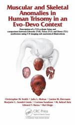 Muscular and Skeletal Anomalies in Human Trisomy in an Evo-Devo Context : Description of a T18 Cyclopic Fetus and Comparison Between Edwards (T18), Patau (T13) and down (T21) Syndromes Using 3-D Imaging and Anatomical Illustrations